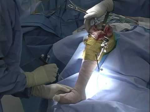 Trattamento delle malattie artritiche articolazioni Moderato osteocondrosi cervicale