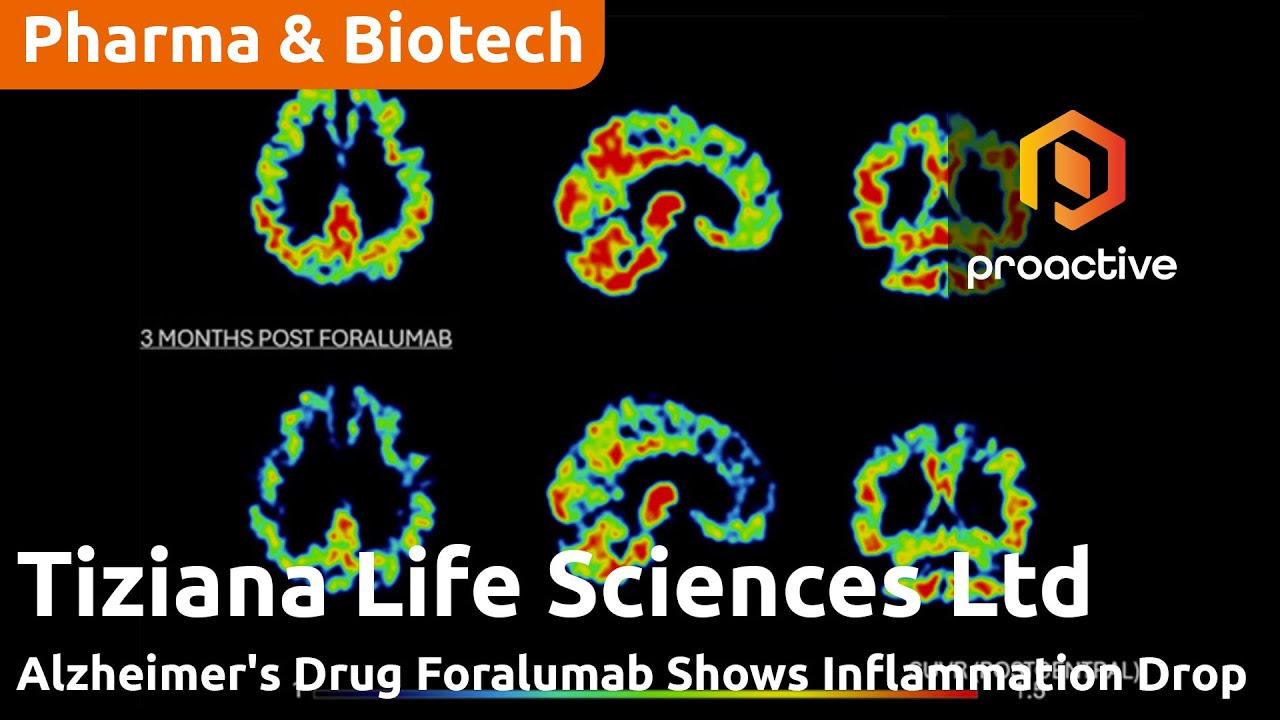 Tiziana Reports PET data sees reduced neuroinflammation in patient treated with Intranasal Therapy