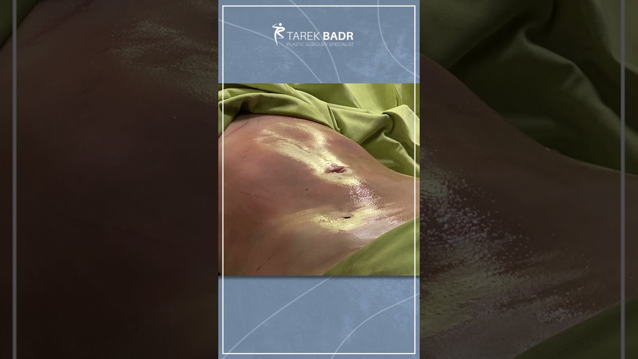 نحت الجسم لشكل أفضل