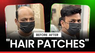 Instant Hair Solution 😍 | Hair Patch Transformation Video
