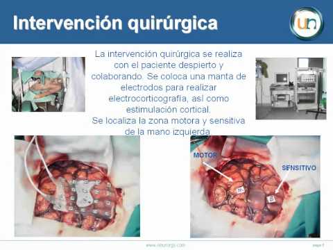 Displasia cortical Rolándica