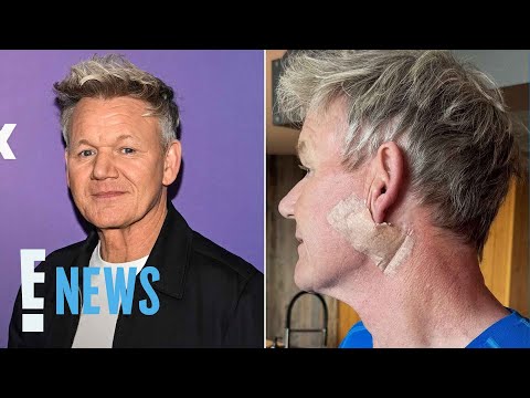 ゴードン・ラムジー、皮膚癌の診断を公表 (Gordon Ramsay Shares Skin Cancer Diagnosis)