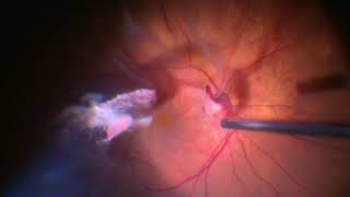 Surgery: Simple Vitreous Hemorrhage: Dr. Manish Nagpal