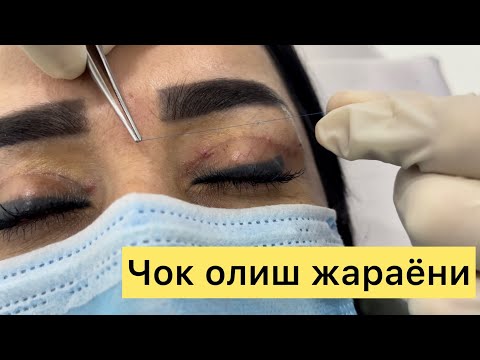 Blefaroplastika natijalari