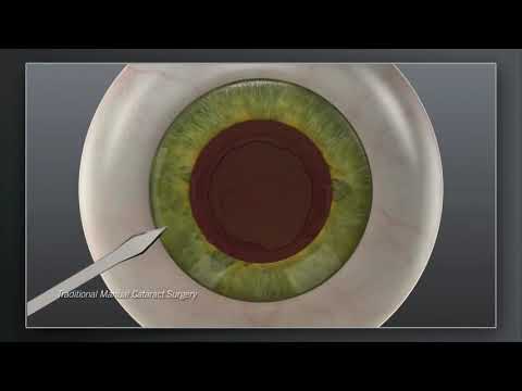 Catalys Laser Cataract Surgery  vs Traditional Manual Animation | Cataract Treatment | #cataracts