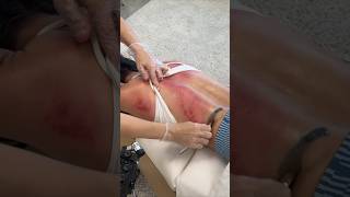 Download lagu Strange Toxins Came out of Her Back 👀 CRUNCHY #chiropractic #guasha #asmr #shorts mp3 Download lagu Strange Toxins Came out of Her Back 👀 CRUNCHY #chiropractic #guasha #asmr #shorts mp3