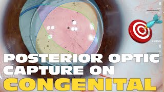 Phaco Clip #210 - Congenital Posterior Polar Cataract
