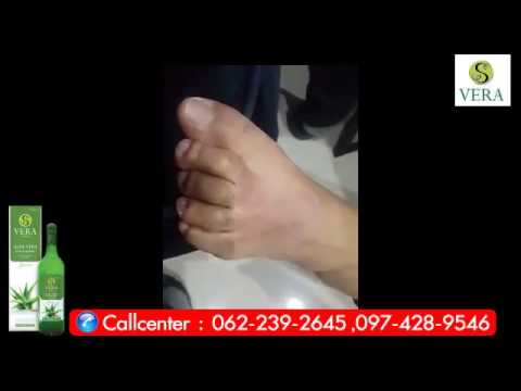 Steatosis และโรคสะเก็ดเงิน Oleoresins สำหรับโรคสะเก็ดเงิน