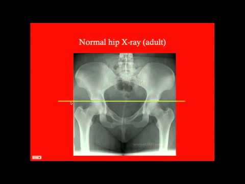 Pediatric Hip/Knee - CRASH! Medical Review Series