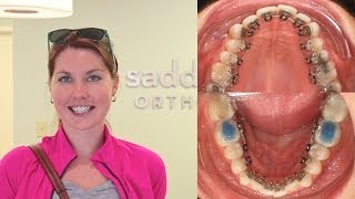 Incognito Hidden Lingual Braces - A Patient's Experience