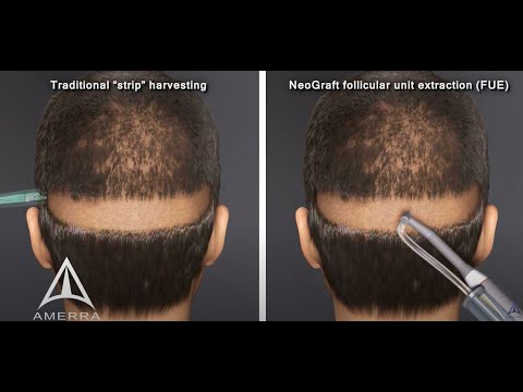 NeoGraft hair transplant procedure - animation Video