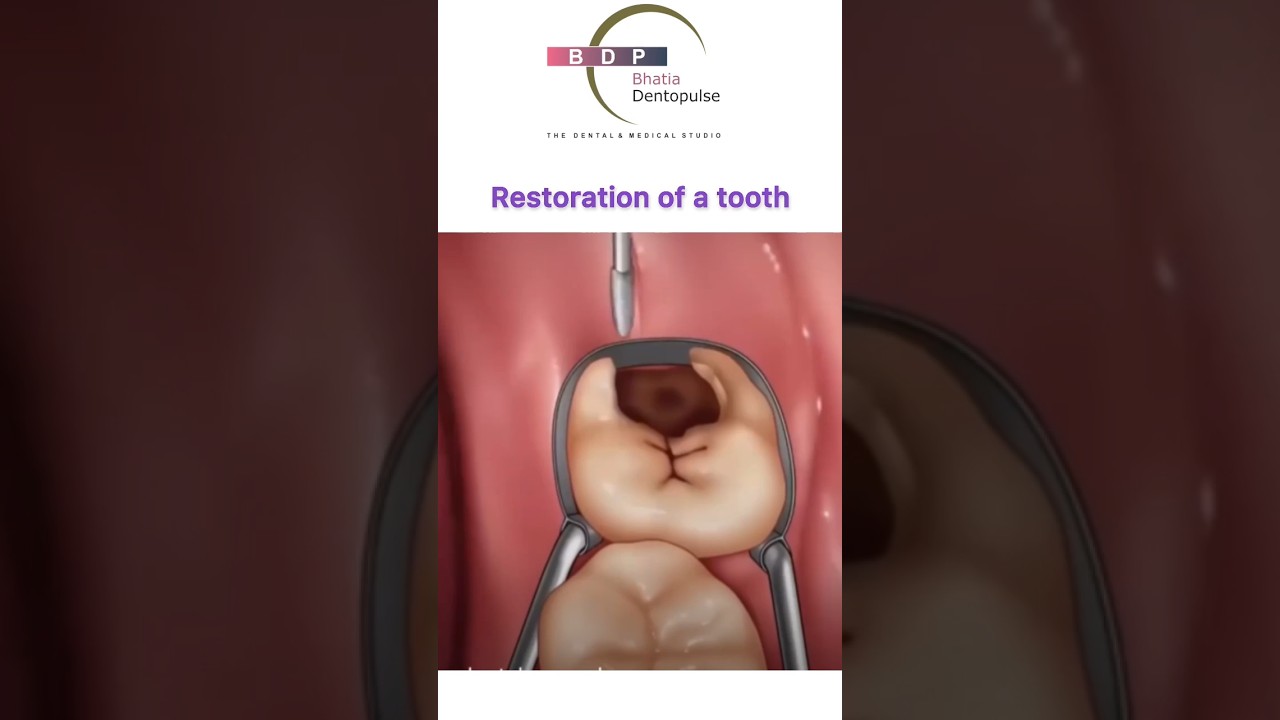 How is tooth cavity removed? #cavity #teeth #dentist