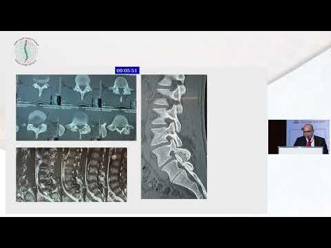 Osteoid Osteoma What Shall I Do? by Dr. Mohamed Fawzy Khattab