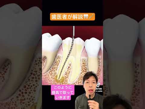 虫歯について詳しく解説