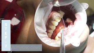 Dental Implants Procedure Breakdown