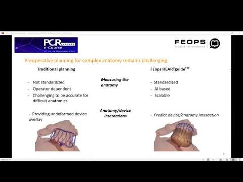 LAAo  with WATCHMAN™ FLX _Dr. Sandeep Panikker