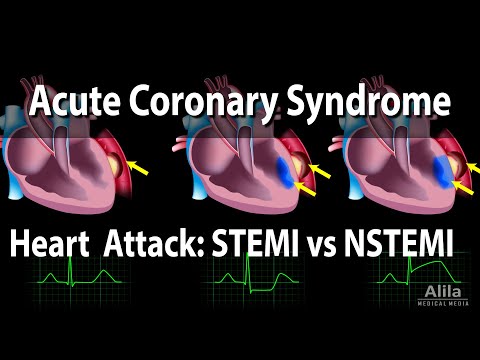 Acute Coronary Syndrome: Unstable Angina, NSTEMI and STEMI (Heart Attack), Animation
