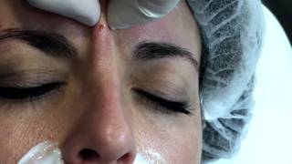 Cómo aplicar el botox para eliminar patas de gallo