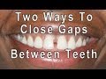 How to Close Gaps Between Teeth 