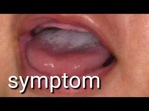 Mouth ulcers in newborn baby