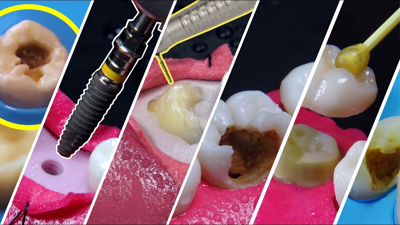 12 BEST dental treatments video compilation in 4K