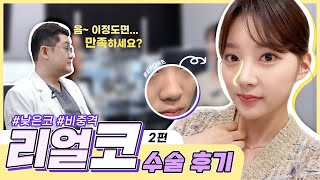 코성형 수술 리얼후기 2편 #코수술후기 #코성형 #비중격만곡증 #낮은코