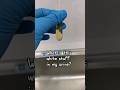 Do You See The White Stuff In Urine Laboratory Microscope Urinalysis Urinesediment Urinecrystal