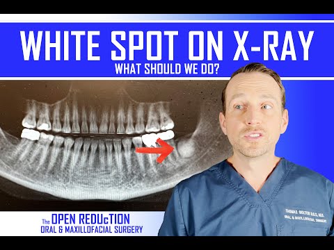 What Is The White Spot on this X-ray? How to Evaluate a Radiopaque Lesion | Oral Pathology