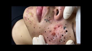 Limpeza de pele | Cravos Gigantes | Muito Satisfatório 🤗