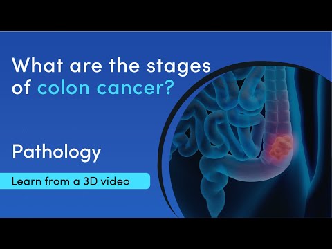 Colon cancer - stage 0 to stage 4 explained in a 3D video | MediMagic