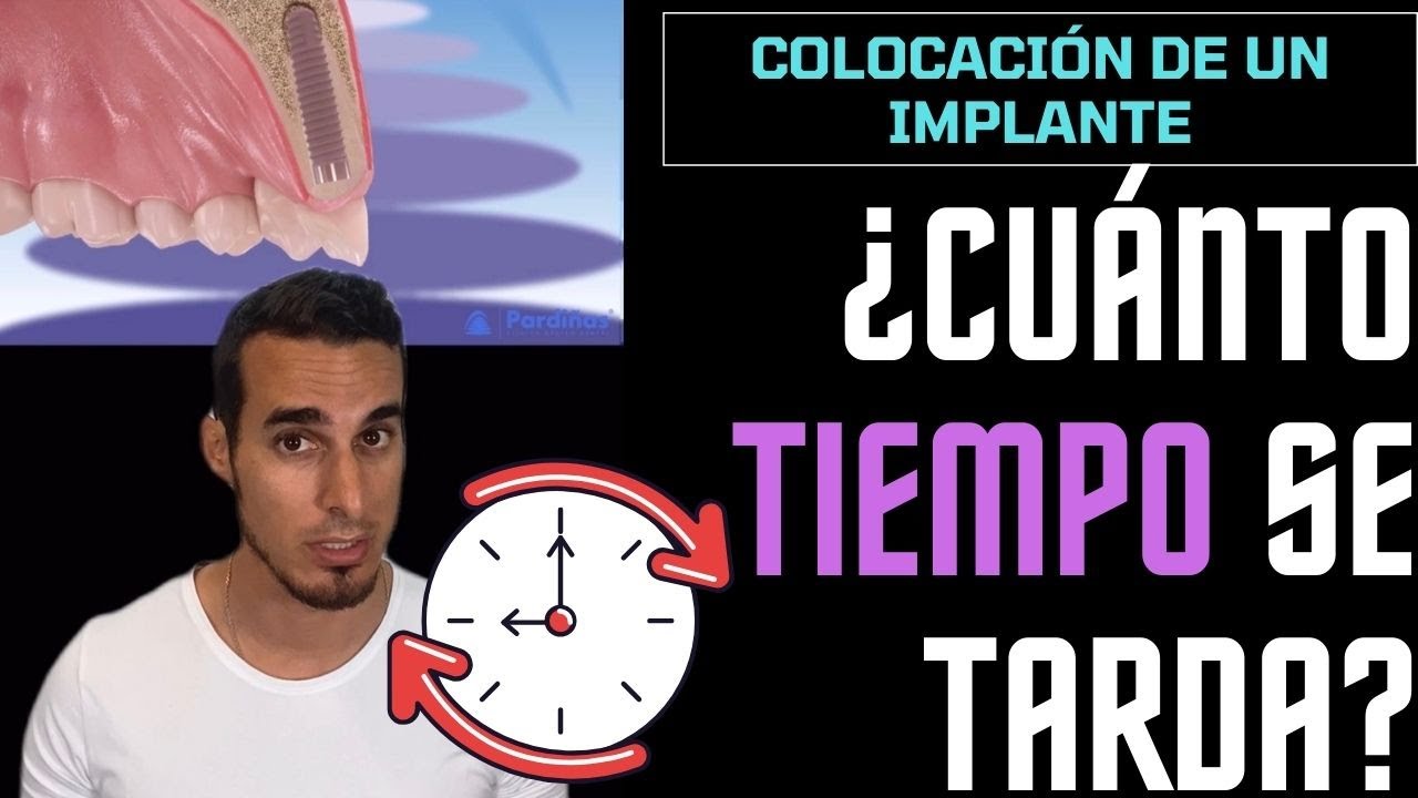 ¿CUÁNTO TIEMPO se tarda en poner un IMPLANTE DENTAL