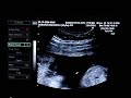 Ultrasound at 18 weeks gestation