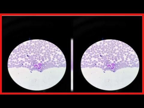 Agranulozytose: Symptome und Behandlung