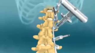 Spinal Fusion for Scoliosis Correction Video | SurgeryLog