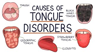 Understanding Tongue Disorders: Causes and Management