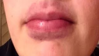 how to get rid of bruises on your lips fast