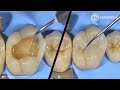 Step by Step Dental Filling (Cavity Filling - Tooth Filling): Cusp Build-Up of a Molar