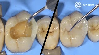 Step by Step Dental Filling (Cavity Filling - Tooth Filling): Cusp Build-Up of a Molar