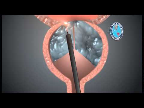 Holmium Laser Enucleation of the Prostate (HOLEP)