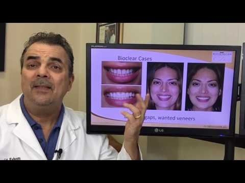 Porcelain Veneers Alternative - Bioclear vs bonding - San Diego Cosmetic Dentist