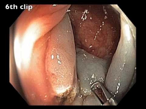 Clip Closure Technique of a Large Transverse Defect