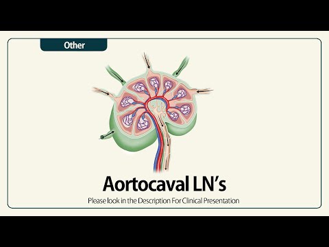 Linear EUS: Aortocaval LN’s