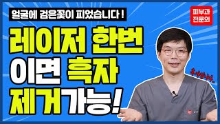 흑자 레이저 1회로 끝내는 방법! (인라이튼SR 532 LST 치료) 재발없이 흑자제거 해볼까요?