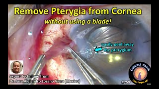 Amazing technique to peel a pterygium off the cornea without a blade!