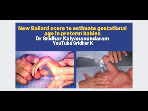 Ballard score. New Ballard score to estimate gestational age in preterm babies. Dr Sridhar K