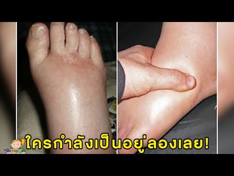 โรคสะเก็ดเงินให้อภัยว่ามันคืออะไร โรคสะเก็ดเงินยาอินเดีย