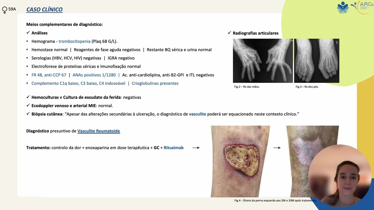 Poster - Vasculite reumatoide