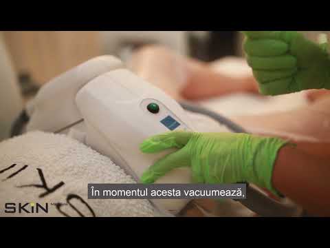 Scapă de grăsimea de pe abdomen, genunchi, coapse❄️Fără efort❄️Criolipoliza SKiN👀Rezultate vizibile