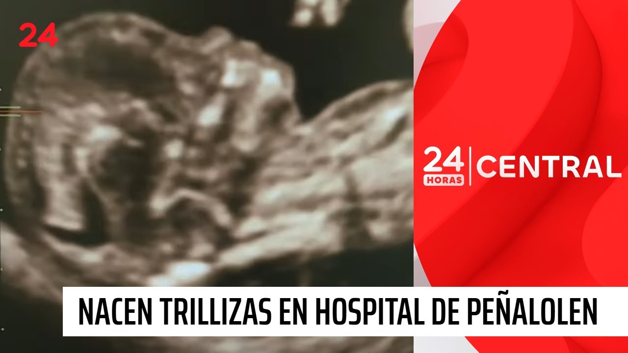 Nacen trillizas: dos de ellas son siamesas | 24 Horas TVN Chile