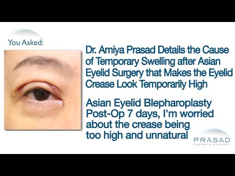 アジアン二重まぶた手術後の一時的な腫れが上まぶたに集中する理由 (Why Temporary Swelling Concentrates in the Upper Eyelids after Asian Double Eyelid Surgery)
